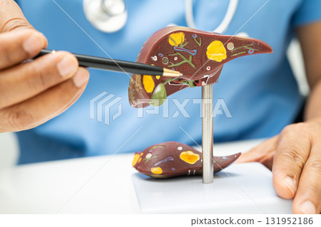 Cirrhosis, Liver cancer, fatty liver, Asian doctor with liver human anatomy model in World Hepatitis Day at hospital. 131952186