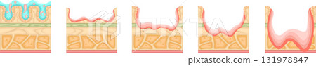 Gastric ulcer severity illustration Gastric ulcer severity illustration 131978847