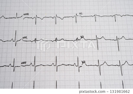 Red heart on electrocardiogram ECG with red heart, heart wave, heart attack, cardiogram report. 131981662