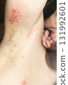 Woman with shingles on the skin she feels very painful 131992601