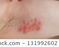 Woman with shingles on the skin she feels very painful 131992602
