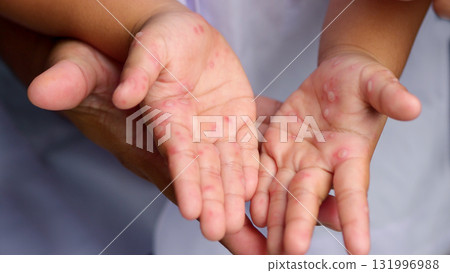 Hand, foot and mouth disease HFMD Human hand of scarlet fever in coxsackievirus palmarosa virus and child hand on white background 131996988