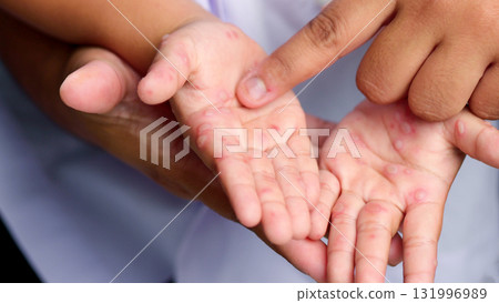 Hand, foot and mouth disease HFMD Human hand of scarlet fever in coxsackievirus palmarosa virus and child hand on white background 131996989