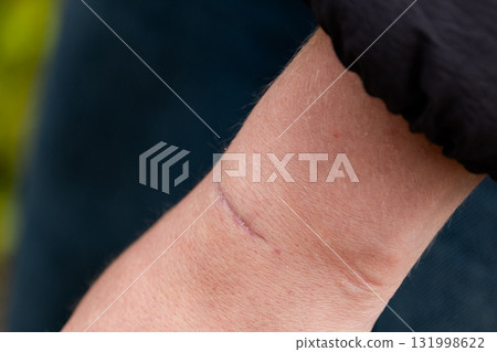 close-up of a scar on the arm after surgery close-up of a scar on the arm after surgery 131998622
