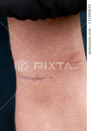 close-up of a scar on the arm after surgery close-up of a scar on the arm after surgery 131998633
