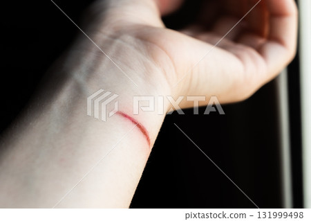 A close-up of a pale arm with a fresh burn mark. The skin shows a red line indicating injury. The background is blurred. A close-up of a pale arm with a fresh burn mark. The skin shows a red line indicating injury. The background is blurred. 131999498