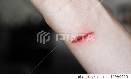 A close-up of a pale arm with a fresh burn mark. The skin shows a red line indicating injury. The background is blurred. 131999503