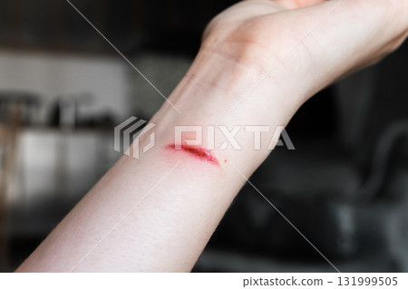 A close-up of a pale arm with a fresh burn mark. The skin shows a red line indicating injury. The background is blurred. 131999505
