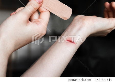 A person applies a medical plaster to a burn on their forearm. The skin is light with a visible red mark from the burn. The plaster is beige and held in one hand. A person applies a medical plaster to a burn on their forearm. The skin is light with a visible red mark from the burn. The plaster is beige and held in one hand. 131999510