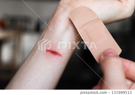 A person applies a medical plaster to a burn on their forearm. The skin is light with a visible red mark from the burn. The plaster is beige and held in one hand. 131999513