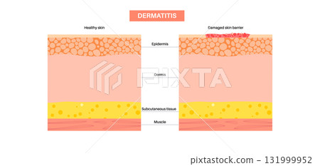 Dermatitis skin disease 131999952