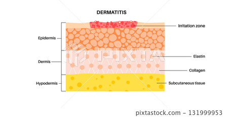 Dermatitis skin disease 131999953