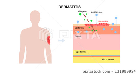 Dermatitis skin disease 131999954
