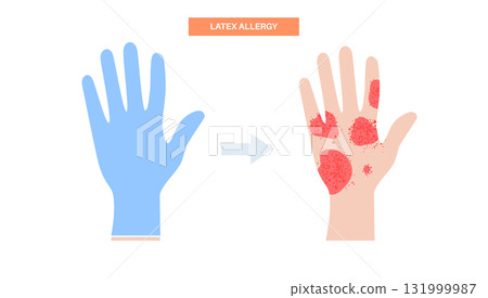 Latex allergy inflammation 131999987
