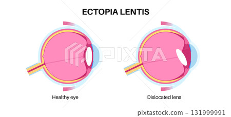 Ectopia lentis disease 131999991