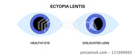 Ectopia lentis disease 131999993