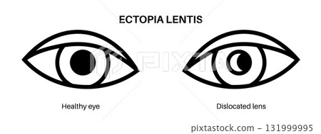 Ectopia lentis disease 131999995