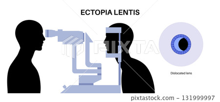 Ectopia lentis disease 131999997