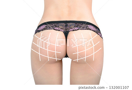 Marking arrow on the buttocks of women before surgery Marking arrow on the buttocks of women before surgery 132001107