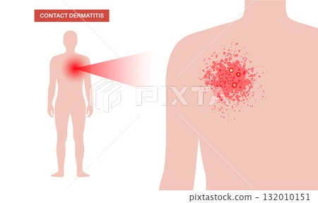 Dermatitis skin disease 132010151