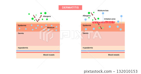 Dermatitis skin disease 132010153