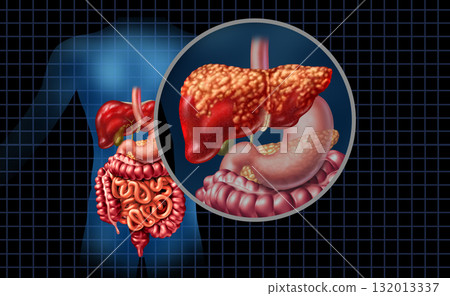 Fatty Liver Disease Fatty Liver Disease 132013337