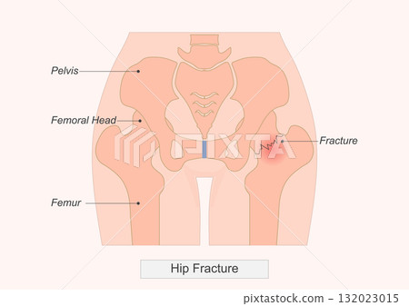 Showing a hip fracture a break in the upper femur near the hip joint. Showing a hip fracture a break in the upper femur near the hip joint. 132023015