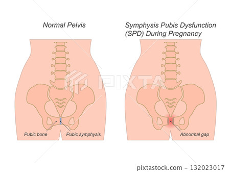 Symphysis Pubis Dysfunction in pregnancy, commonly occurring in the second or third trimester. Symphysis Pubis Dysfunction in pregnancy, commonly occurring in the second or third trimester. 132023017