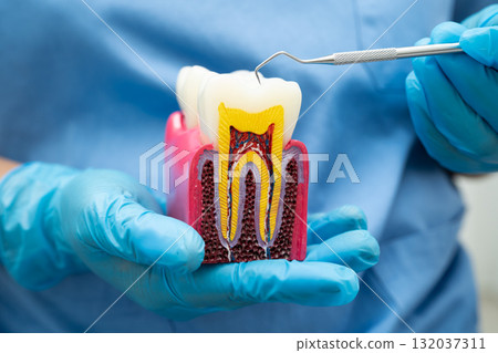 Dentist holding dental implant, artificial tooth roots into jaw, root canal of dental treatment, gum disease, teeth model for dentist. 132037311
