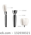 Dental implant structure infographic. Realistic 3D illustration with labeled components on white background for medical and educational use. 132038321