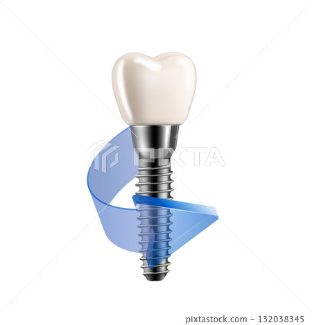 Dental implant with blue arrow. Realistic 3D render on white background for medical and professional use. Dental implant with blue arrow. Realistic 3D render on white background for medical and professional use. 132038345
