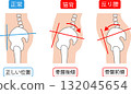矯正骨盆位置、骨盆後傾和骨盆前傾 132045654
