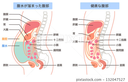 腹水腹部和健康腹部 腹水腹部和健康腹部 132047527