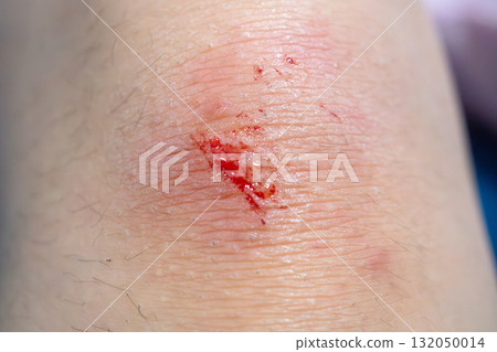 wound on child knee after fall on the ground 132050014