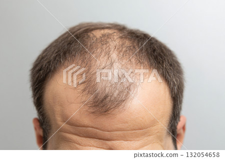 Male pattern baldness and hair loss on scalp, close-up Male pattern baldness and hair loss on scalp, close-up 132054658