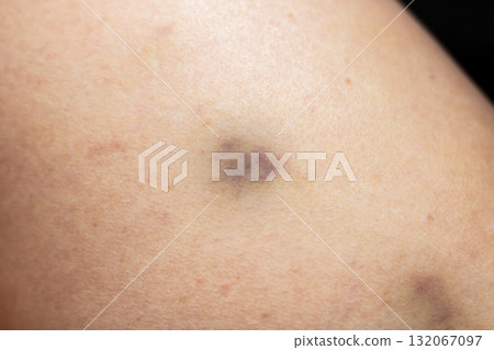 Close-up of bruises on light skin - healing discoloration Close-up of bruises on light skin - healing discoloration 132067097