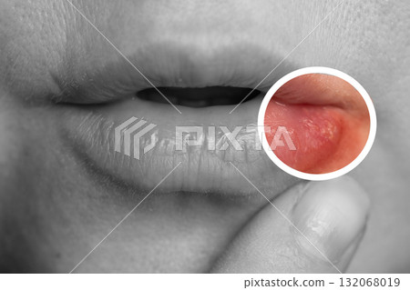 Close up of Lip Affected by Herpes Simplex Virus Infection 132068019