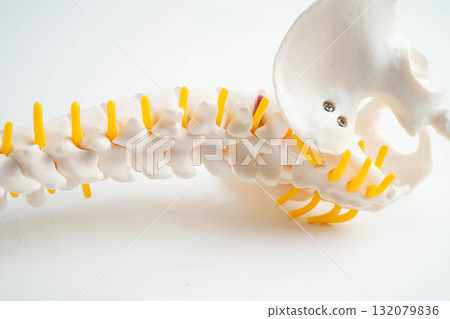 Spinal nerve and bone, Lumbar spine displaced herniated disc fragment, Model for treatment medical in the orthopedic department. 132079836