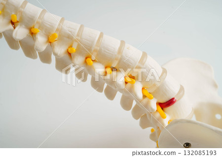 Spinal nerve and bone, Lumbar spine displaced herniated disc fragment, Model for treatment medical in the orthopedic department. 132085193
