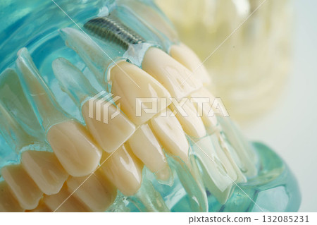 Dental implant, artificial tooth roots into jaw, root canal of dental treatment, gum disease, teeth model for dentist studying about dentistry. Dental implant, artificial tooth roots into jaw, root canal of dental treatment, gum disease, teeth model for dentist studying about dentistry. 132085231