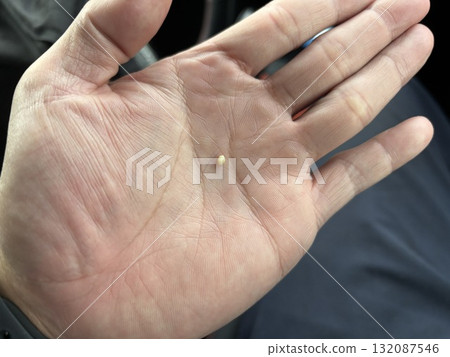 口腔內有膿栓，氣味難聞 132087546