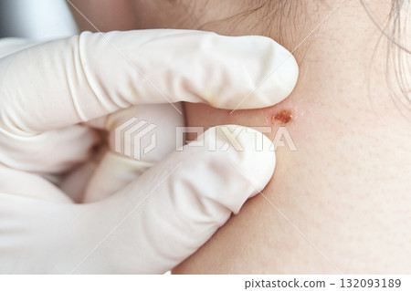 Caucasian adult skin examination by gloved hands checking mole on neck 132093189