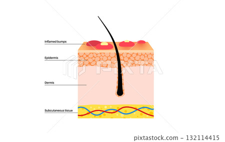 Dermatitis skin disease 132114415