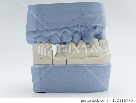 Dental cast with crown preparation on molar Dental cast with crown preparation on molar 132116770