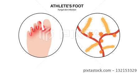Athletes foot inflammation 132153329