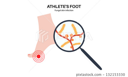 Athletes foot inflammation Athletes foot inflammation 132153330
