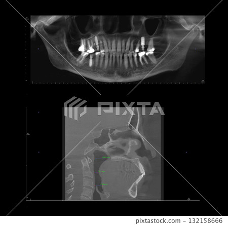 X-ray of an adult patient showing teeth, jaws, dental implant, mandibular joint. Computed tomography of adult female patient with Temporomandibular joint (TMJ, joint of lower jaw), implant treatments X-ray of an adult patient showing teeth, jaws, dental implant, mandibular joint. Computed tomography of adult female patient with Temporomandibular joint (TMJ, joint of lower jaw), implant treatments 132158666