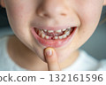 Close-up of child smiling mouth with missing baby tooth and pointing finger. A proud moment of growing up and celebrating childhood milestones. 132161596