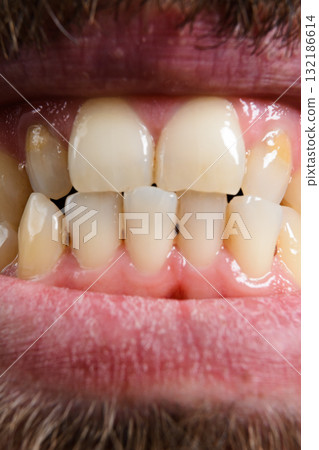 Close-up of adult teeth and gums. Close-up of adult teeth and gums. 132186614