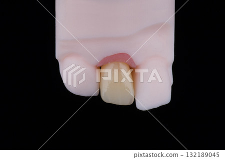 Mirror copy of lateral maxillary incisor, zirconia crown on titanium abutment fixed on printed model 132189045